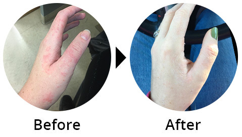 Before and after: red eczema patches on the back of the hand, cleared