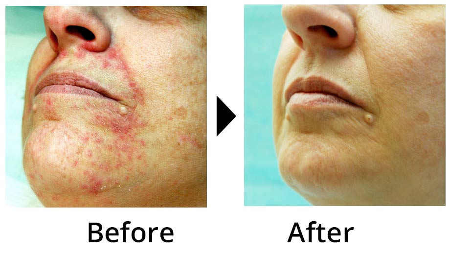 Before and after: perioral dermatitis bumps around the mouth and chin, cleared